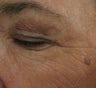 Crows feet and eye wrinkles treated with 1 treatment of Lux 1540 Fractional Laser