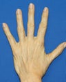 Hand Rejuvenation with Filler