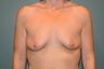 Breast Implants