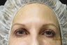 Ultherapy Eye Lift