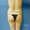 Brazilian Buttock Augmentation