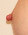 Before and After Nipple Reduction (Length)