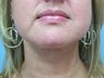 Liposuction to the chin area
