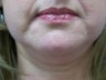 Liposuction to the chin area
