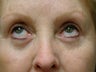 Eyelid Surgery, Upper and Lower Blepharoplasty