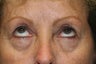 Eyelid Surgery, Upper and Lower Blepharoplasty