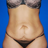 Tummy Tuck