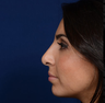 Rhinoplasty
