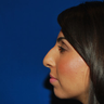 Rhinoplasty