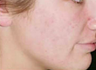 Mesotherapy