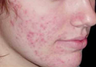 Mesotherapy