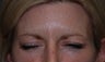 Botox to Forehead and Frown Wrinkles