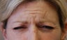 Botox to Forehead and Frown Wrinkles