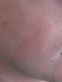 24 year old Male with Rosacea