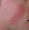 24 year old Male with Rosacea