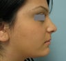 Rhinoplasty