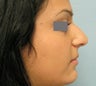 Rhinoplasty
