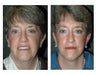 Facelift