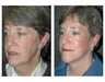 Facelift