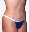 Tummy Tuck