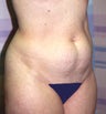 Tummy Tuck
