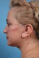 Necklift Patient