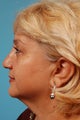 Necklift Patient