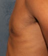 Male Breast Reduction-Gynecomastia