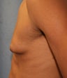 Male Breast Reduction-Gynecomastia