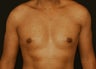 Gynecomastia