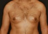 Gynecomastia