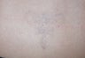 Unwanted tattoo in an adult