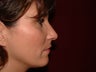 Rhinoplasty