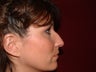 Rhinoplasty