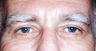 Eyelid Surgery