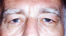 Eyelid Surgery