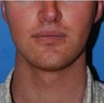 Before and After Laterasl Jaw Augmentation with Silicone Implants
