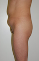 buttock Augmentation