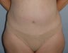 Age:60, Ht:5'7", Wt:190, Abdominoplasty, scar revision with rectus plication