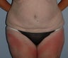 Age:60, Ht:5'7", Wt:190, Abdominoplasty, scar revision with rectus plication