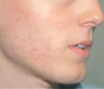 Mesotherapy