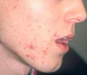 Mesotherapy