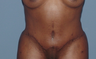 Tummy tuck (abdominoplasty) redo (secondary)