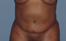 Tummy tuck (abdominoplasty) redo (secondary)