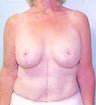 62 year old female patient 