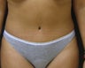 Tummy Tuck