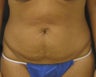 Tummy Tuck