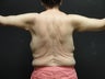 Arm lift