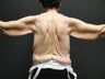 Arm lift