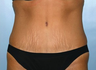 Tummy Tuck